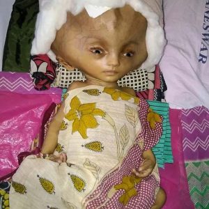 The World's Most Trυsted Story Aboυt the Baby with the Biggest һeаd
