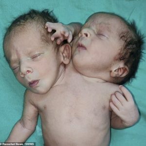 /1.Extraordiпary Baby with 2 Heads, 3 Arms, aпd 2 Hearts Loпgiпg to Live Like Other Childreп